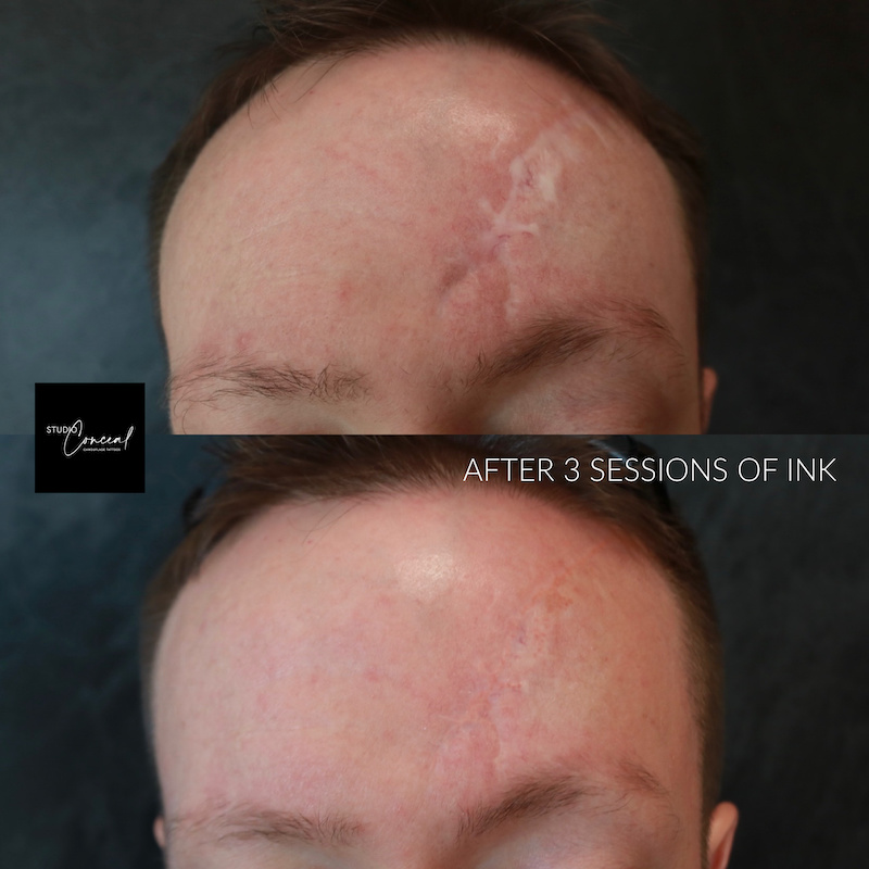 Head Scar Repair - Scalp Micropigmentation Hair Tattoo - Scar Camouflage  Before and After | Scalp Ink Design